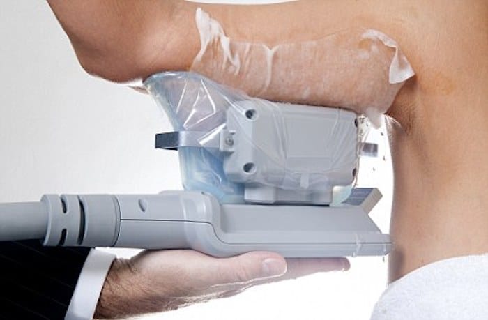fat freezing arms Cleveleys