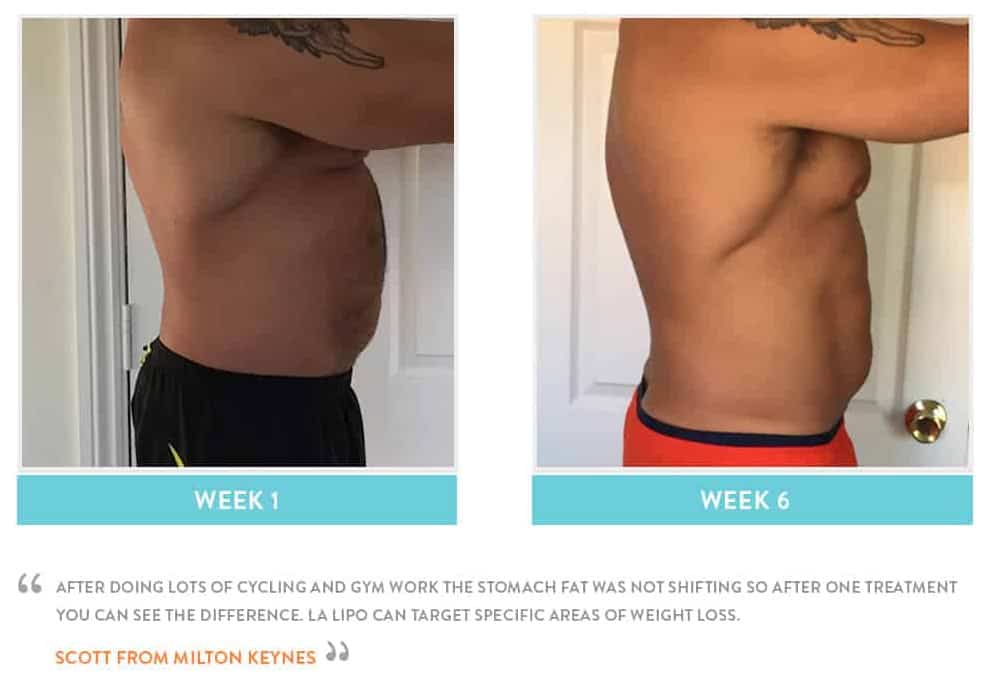 Before & After Stomach Fat Cleveleys