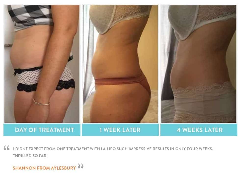 before, Cryolipolysis Cleveleys