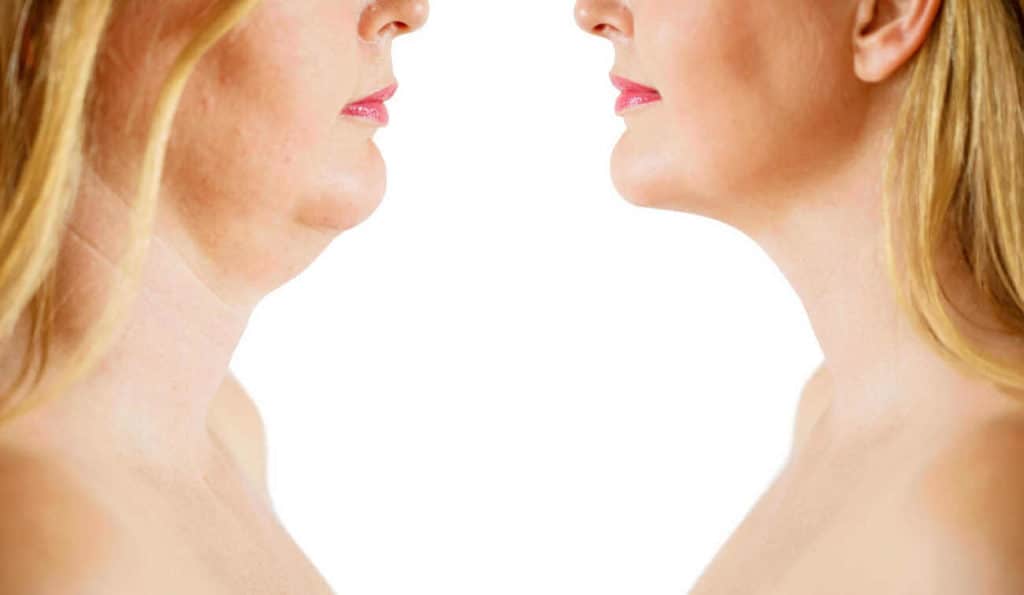 Double Chin treatment Cleveleys before and after results