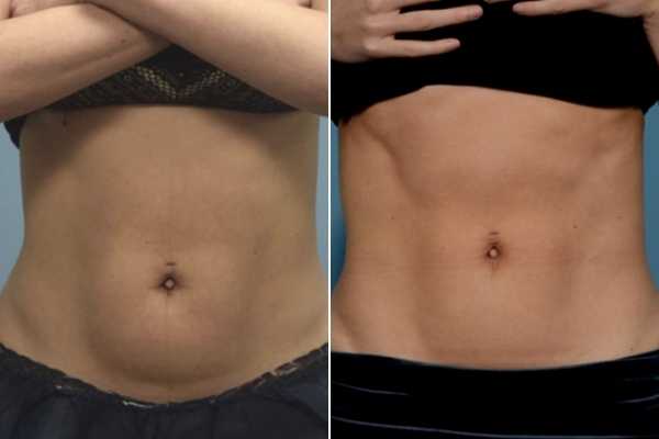 body sculpting FAQs Cleveleys