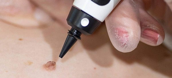After Skin Tag Removal Cleveleys