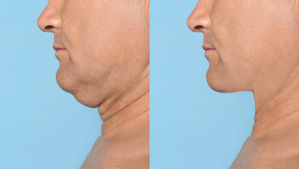 Which Non-Surgical Treatments Work Best for Jowls and Loose Skin Cleveleys?
