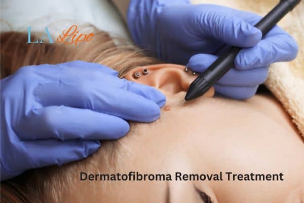 Dermatofibroma Removal Treatment Cleveleys