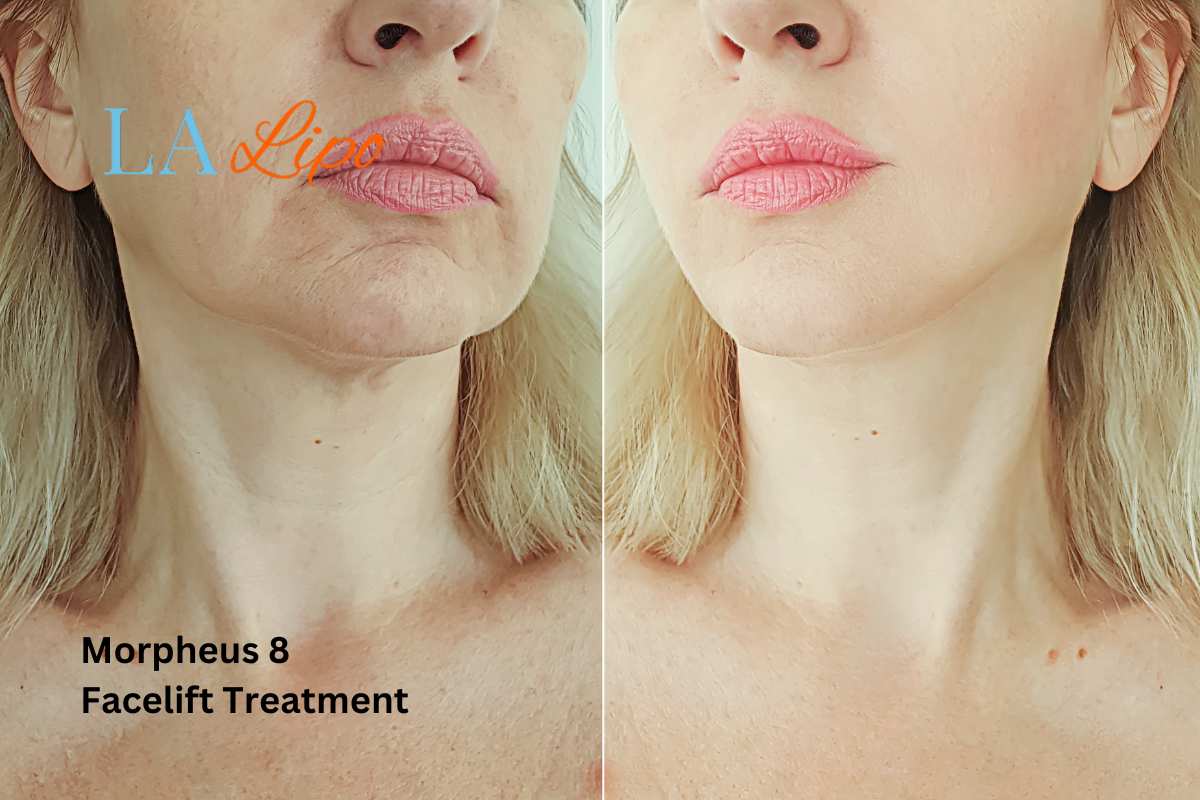 Turn back time with Morpheus8 Treatment Cleveleys