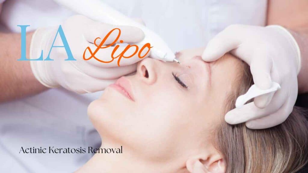 actinic keratosis removal Cleveleys