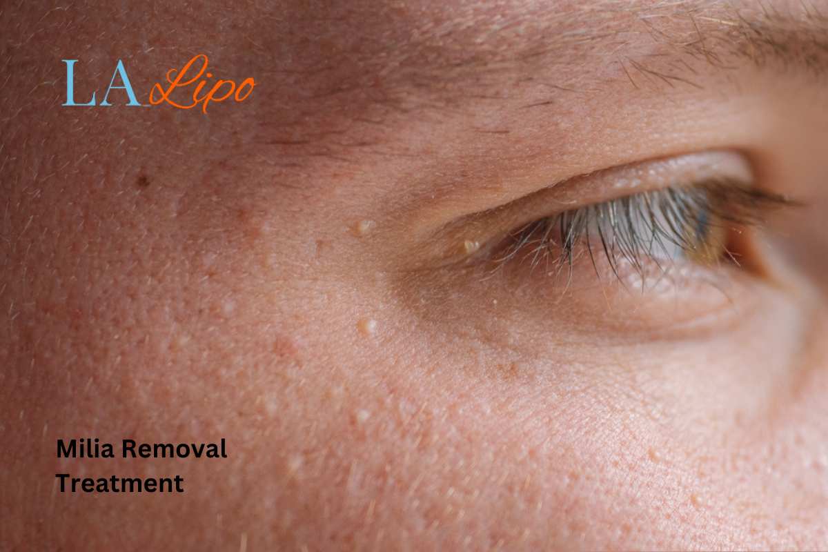 Cryopen Milia Removal: Is It the Easiest and Safest Option Cleveleys?