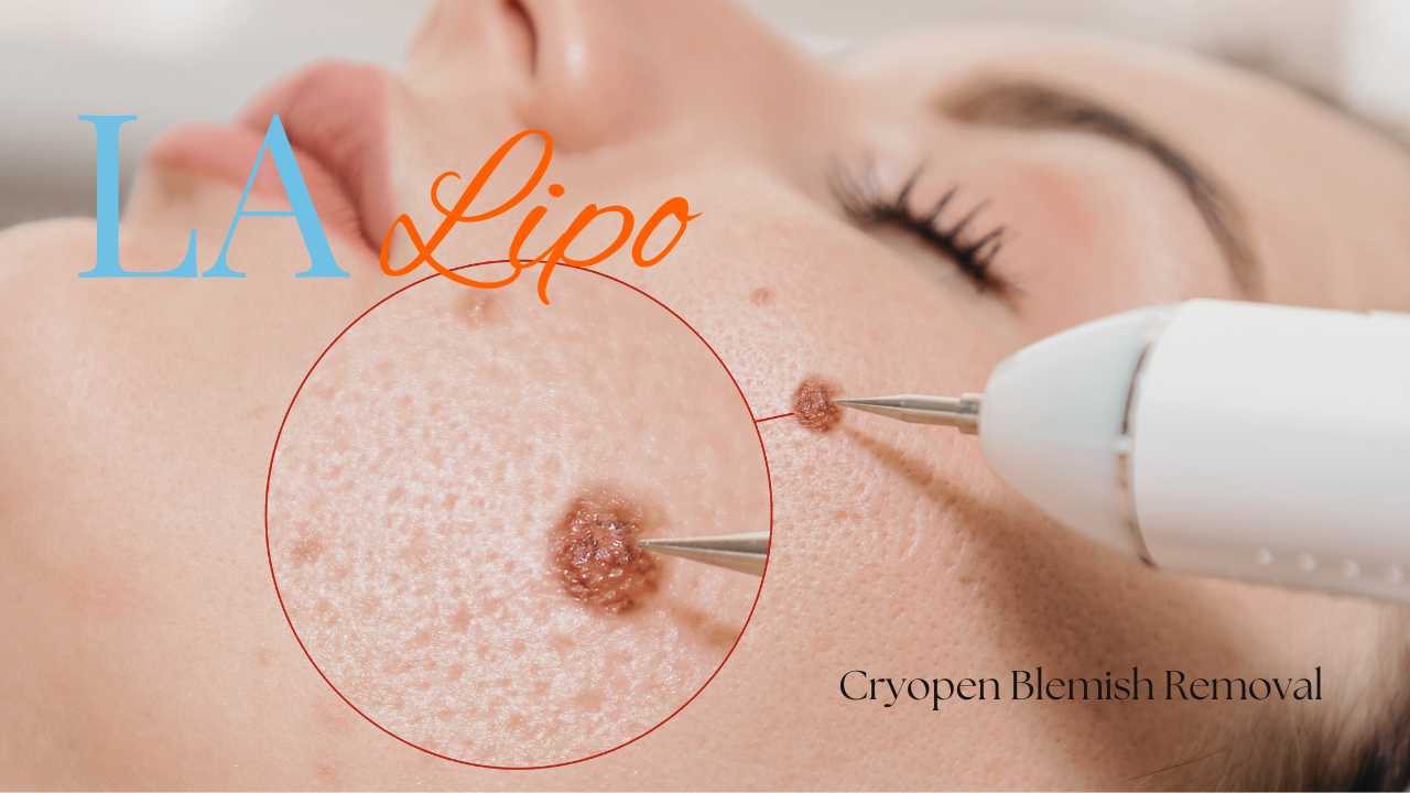 cryopen blemish removal Cleveleys Contact our team today!