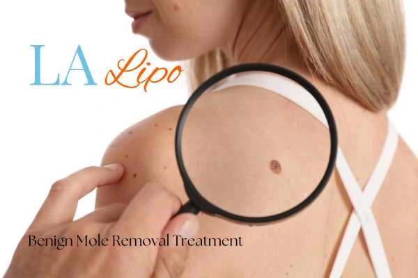 Why getting moles removed Cleveleys can boost your confidence!