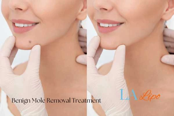 woman's before and after mole removal Cleveleys results