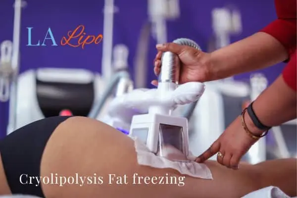 women getting fat freezing Cleveleys