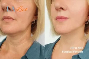 hi-fu for wrinkles Cleveleys before and after results