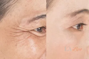 Before and after results of woman - HI-fu wrinkles reduction treatment Cleveleys