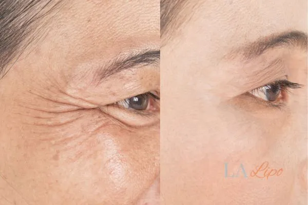 Before and after results of woman - HI-fu wrinkles reduction treatment Cleveleys