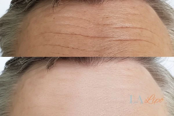results of HIFU Cleveleys on mans forehead to help reduce lines and wrinkles