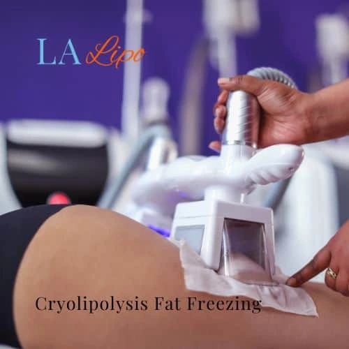 fat freezing - Cryolipolysis Cleveleys