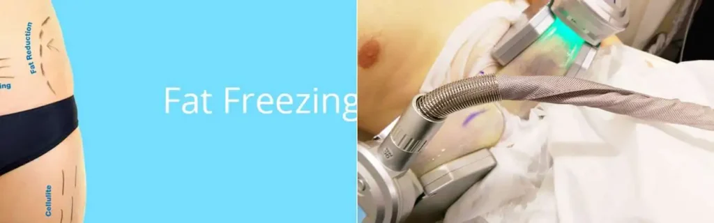 multi areas of a persons body having coolsculpting Cleveleys treatment