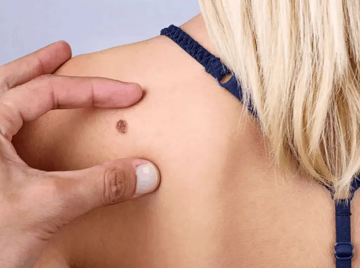 woman having mole removal Cleveleys consultation before treatment.