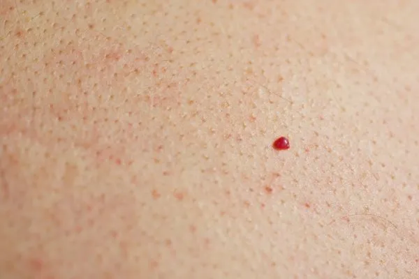 close up of a cherry angioma Cleveleys