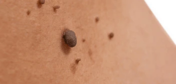 image of a skin tag Cleveleys