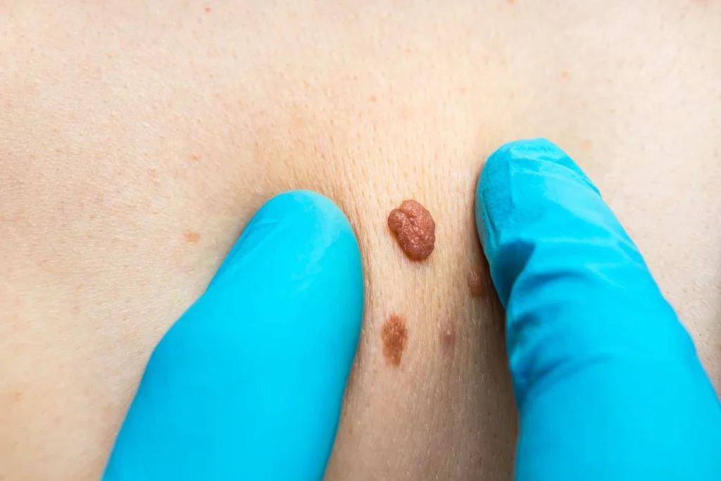 Consultant examining a skin tag Cleveleys