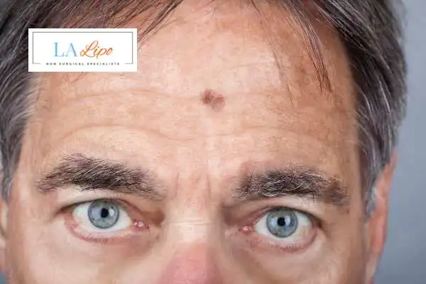 Solar Lentigo Removal Cleveleys image of man with mark on his forehead