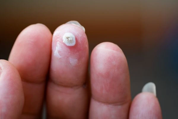 wart on person finger - cryotherapy to treat from LA LIPO Cleveleys