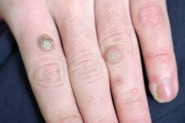 photo of warts on person hand - see wart removal Cleveleys from LA LIPO