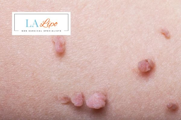 Does cryopen skin tag removal Cleveleys hurt? Find out now call our team today!
