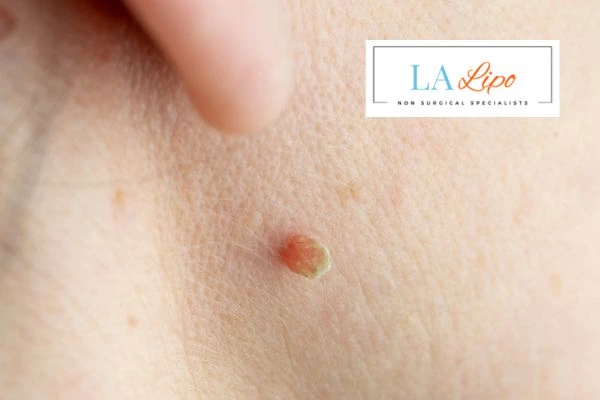 Book skin tag removal Cleveleys today speak to our team now!