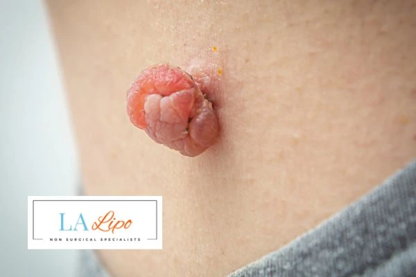 Interested in skin tag removal Cleveleys? Concerned about the pain? Find out more today!