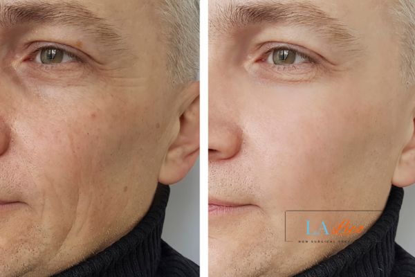 See the amazing results of Morpheus8 Treatment Cleveleys!
