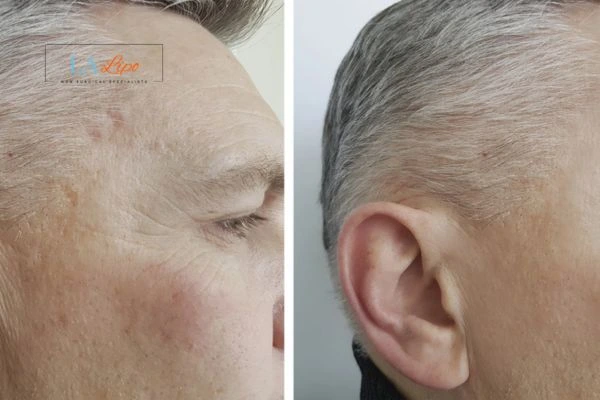 Mens Before & After Morpheus 8 Results Cleveleys