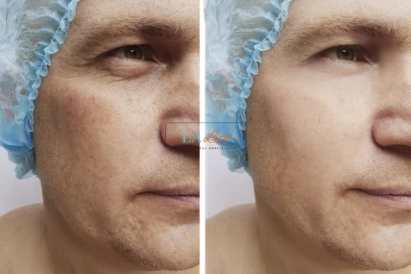 Before and after Morpheus 8 Results Cleveleys