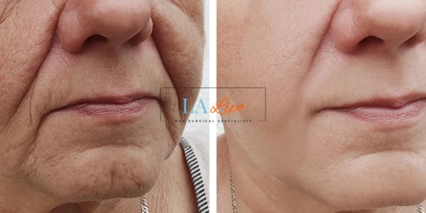 Older lady deeper wrinkle reduction - LA LIPO Morpheus 8 Results Cleveleys