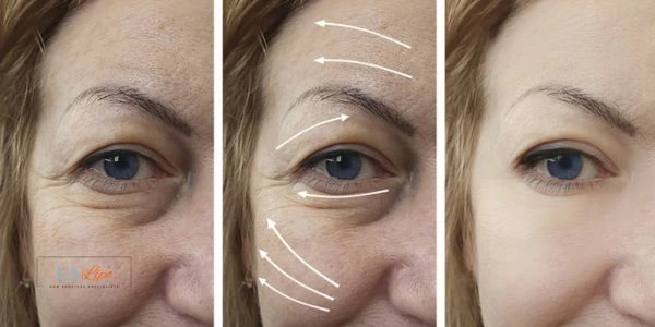 Amazing eye lift Morpheus 8 results Cleveleys