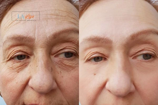 The powerful benefits of Morpheus8 Treatment Cleveleys - Call Our team today!