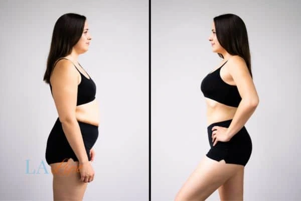 Picture of womans before and after using LA-EMS body sculpting to improve her core strength Cleveleys