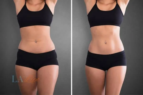 before and after results of non-surgical treatment to help a woman's body image and mental health Cleveleys