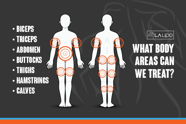 Diagram to show areas you can have LA-EMS Body Sculpting Treatment Cleveleys