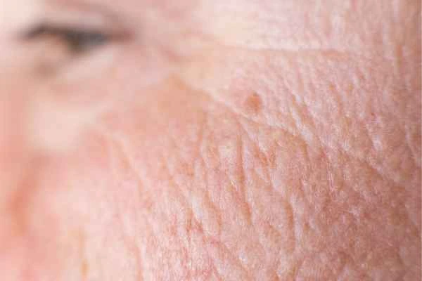 close up picture of a woman's face showing an age spot Cleveleys