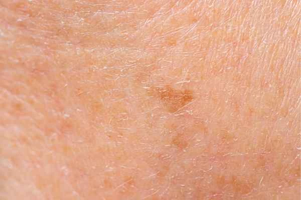 close up picture of age spots Cleveleys