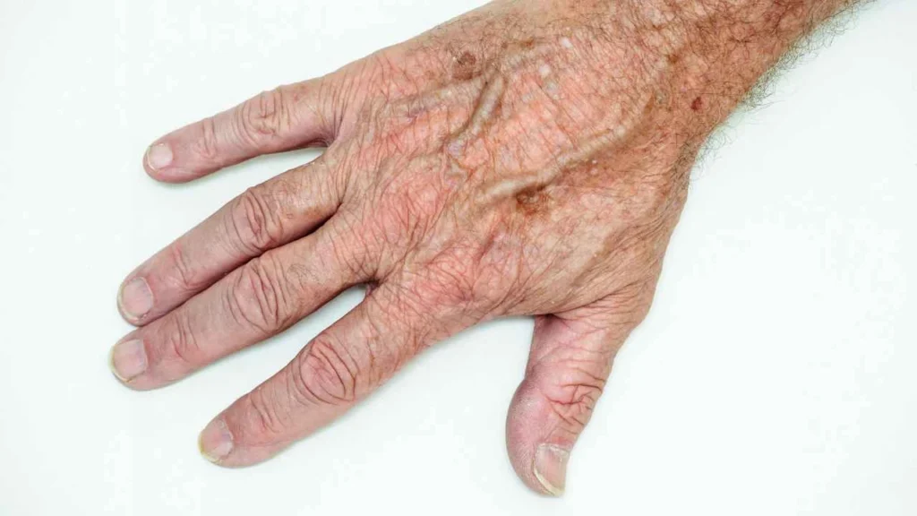 Male hand showing age spot Cleveleys