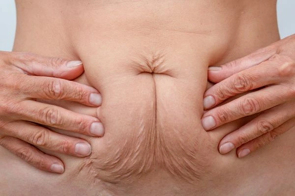 Image of a woman's stomach with loose skin - example of skin tightening Cleveleys options