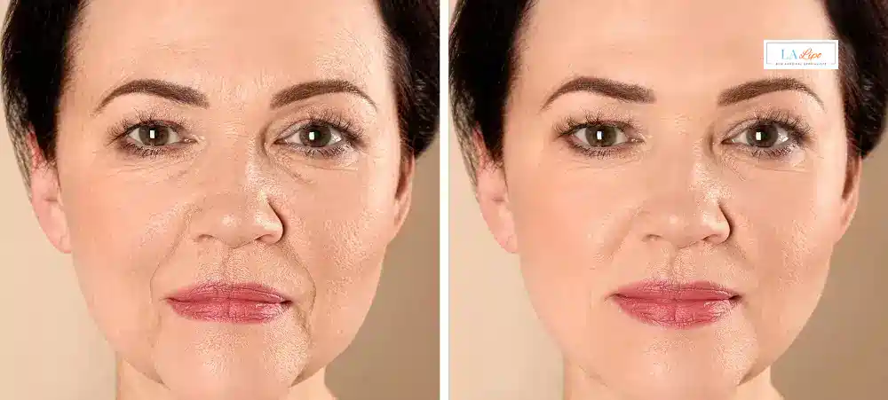How Long Does It Take to See Results and How Long Do They Last Cleveleys?