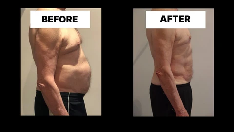 What Symptoms Can Diastasis Recti Cause in Men? Weak Core, Back Pain and Poor Posture Cleveleys